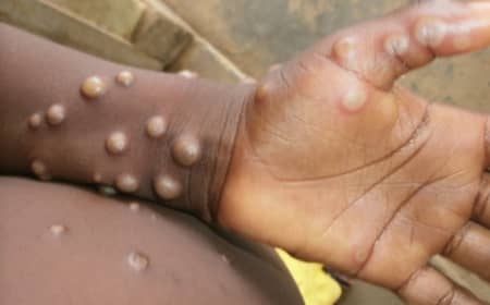 Un premier cas confirmé de la Mpox notifié à Beni